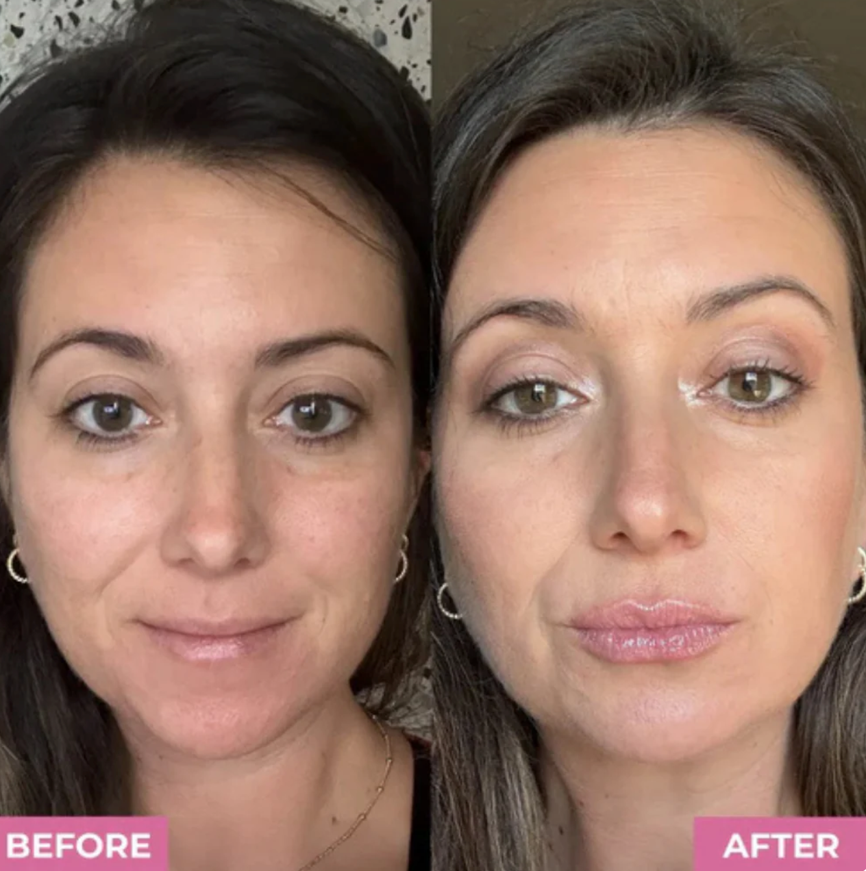 Zorla™ Lip Roller