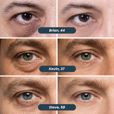 Microneedle Patches | New Generation