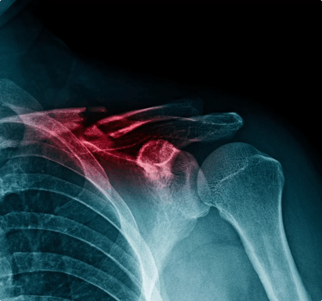 X-ray bone image