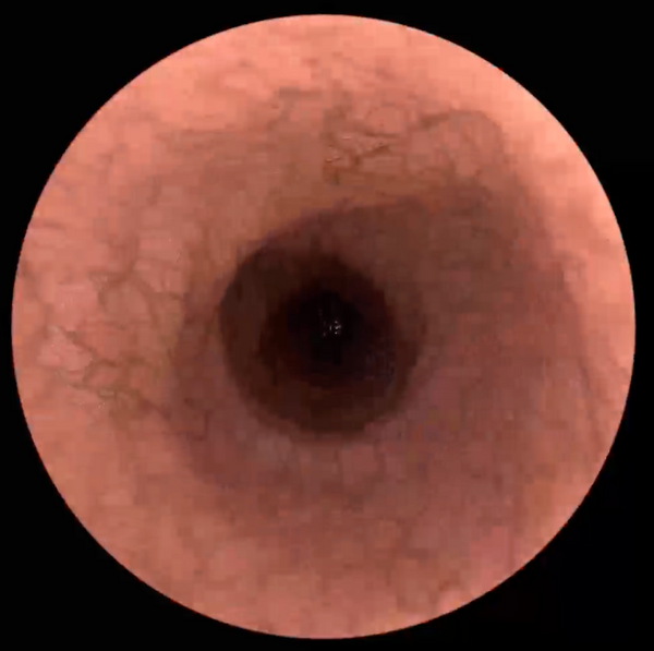 Esophagus close-up