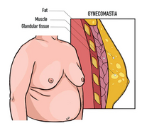 Gynecomastia