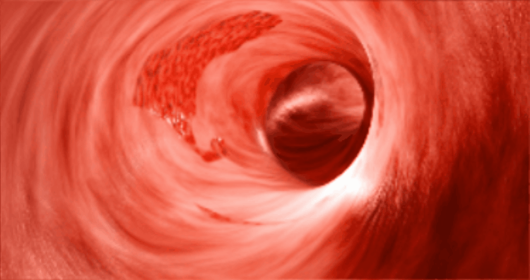 Artery inflammation illustration