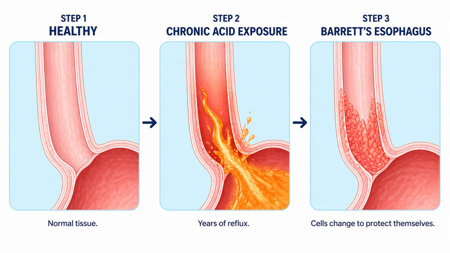 Barrett's progression diagram